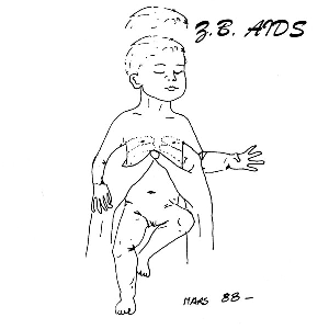 Z.b. Aids – Gestalt